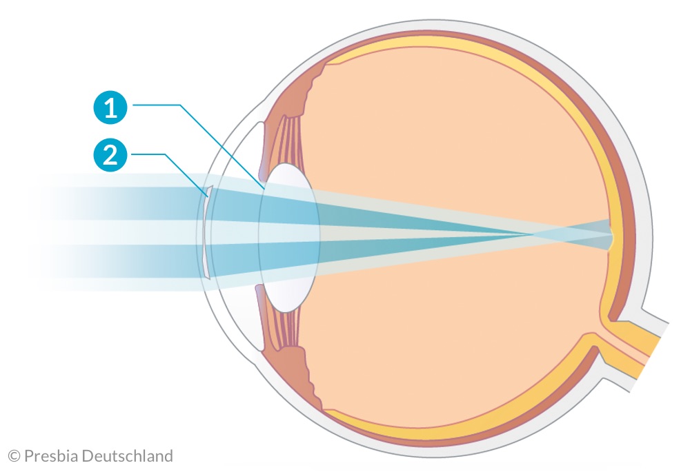 Illustration des Auges mit einer implantierten Presbia Flexivue Microlens und Lichtstrahlen aus der Ferne, die auf der Netzhaut fokussiert werden.
