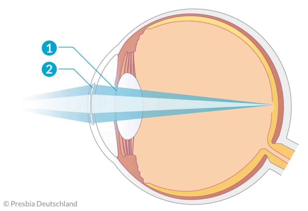 Illustration des Auges mit einer implantierten Presbia Flexivue Microlens und Lichtstrahlen aus der Nähe, die auf der Netzhaut fokussiert werden.